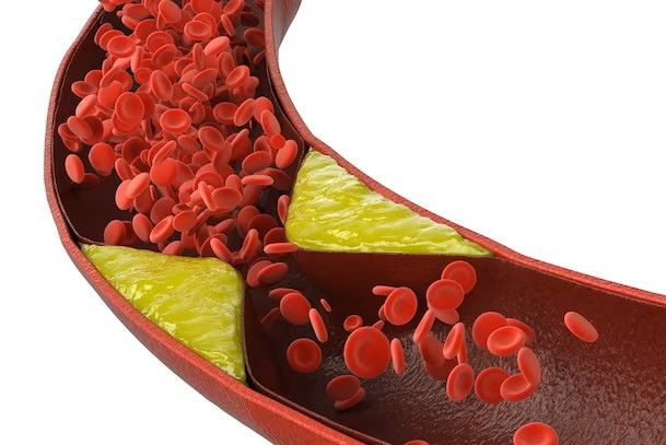 Инсульт-тромбоз.jpg Инсульт-тромбоз.jpg